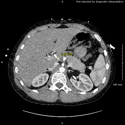 Embolisation of Hepatic Artery Aneurysm in Vascular Ehlers-Danlos Syndrome